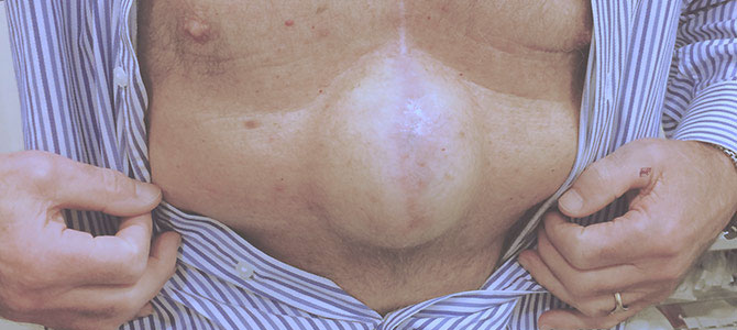 Incisional Hernia