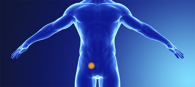 Inguinal Hernia